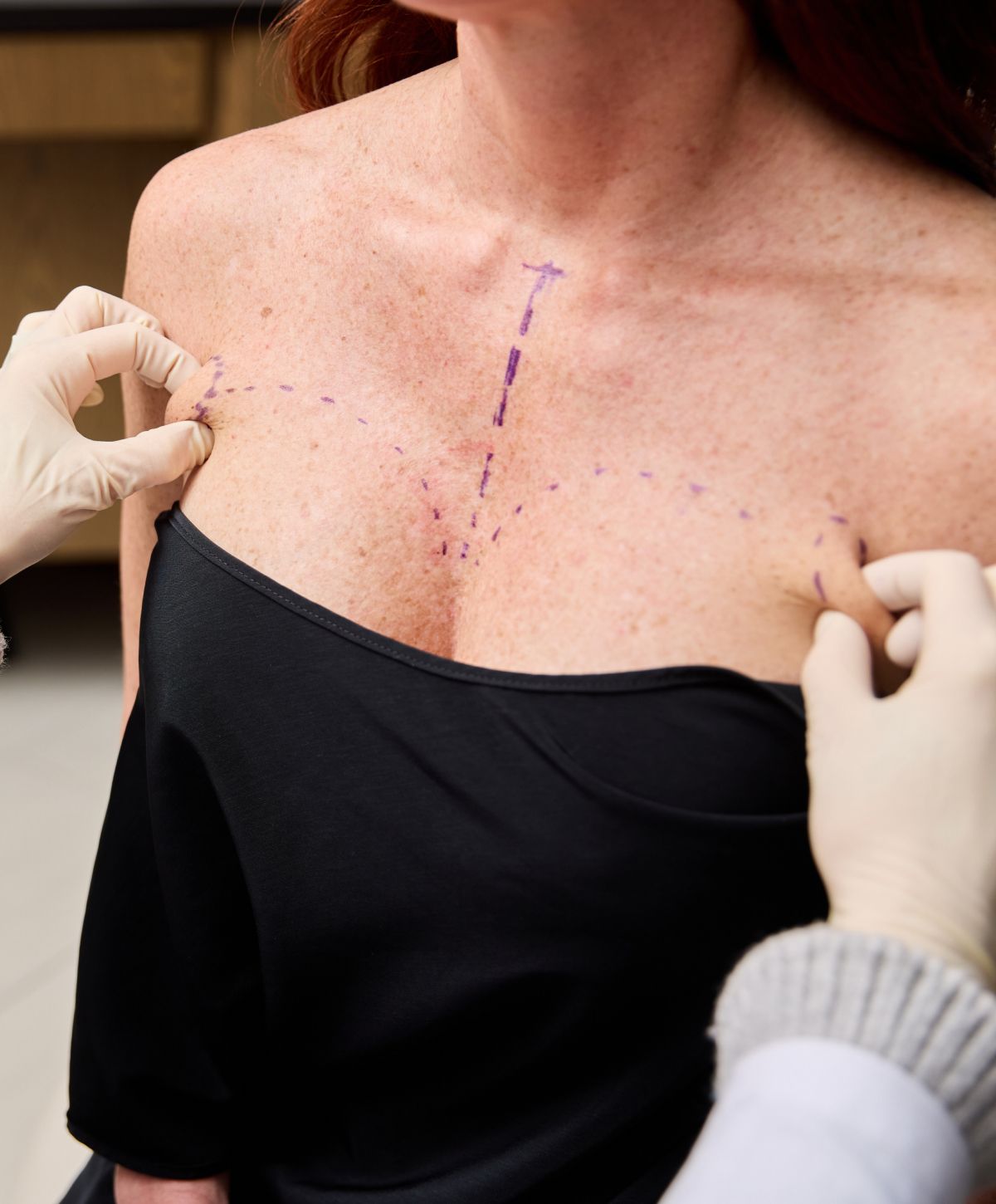 Patient marking for medical procedure preparation.