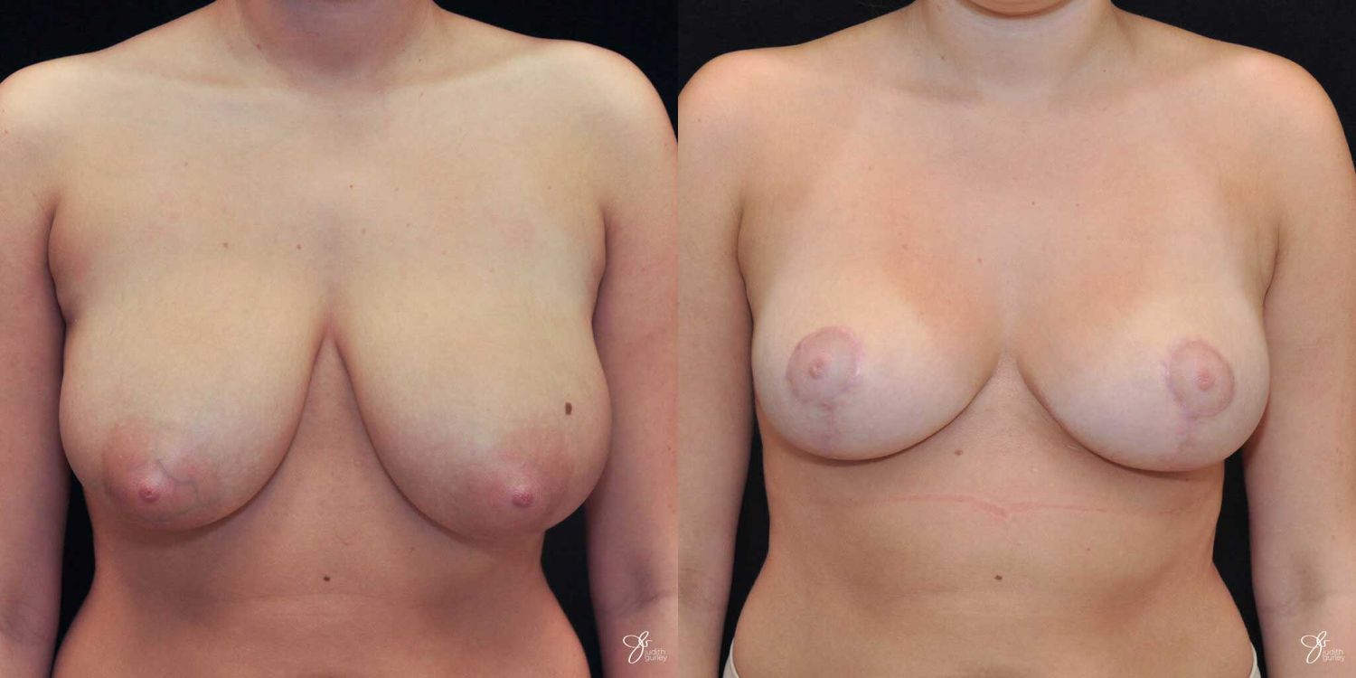 Before and after breast enhancement comparison image.