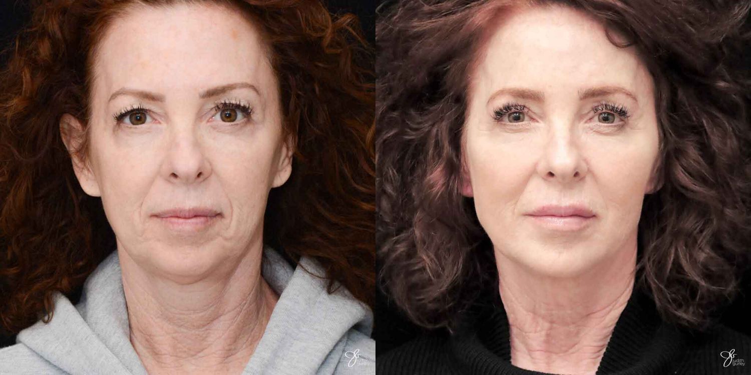 Before and after transformation of a woman.