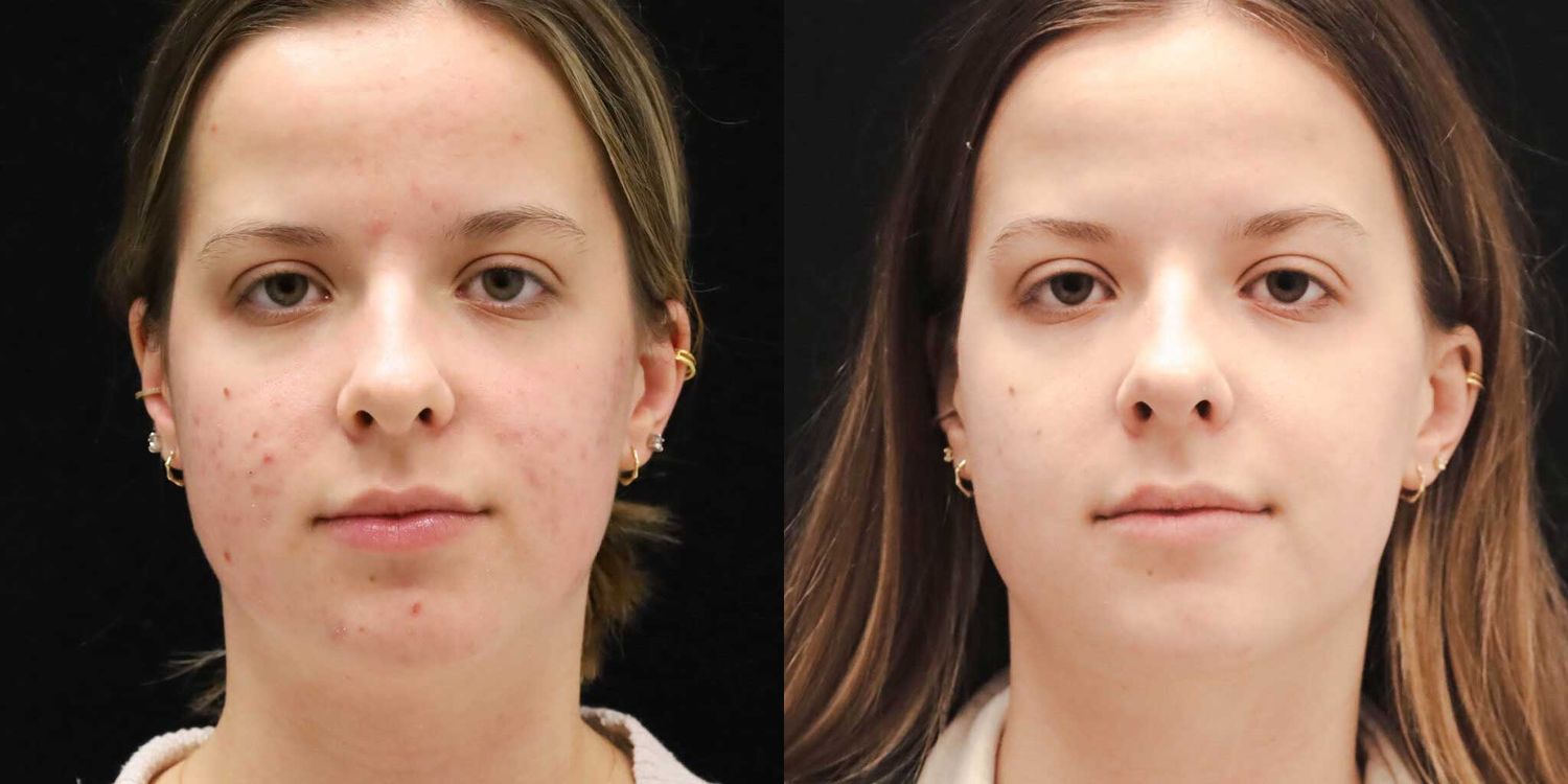 Before and after skincare treatment results.