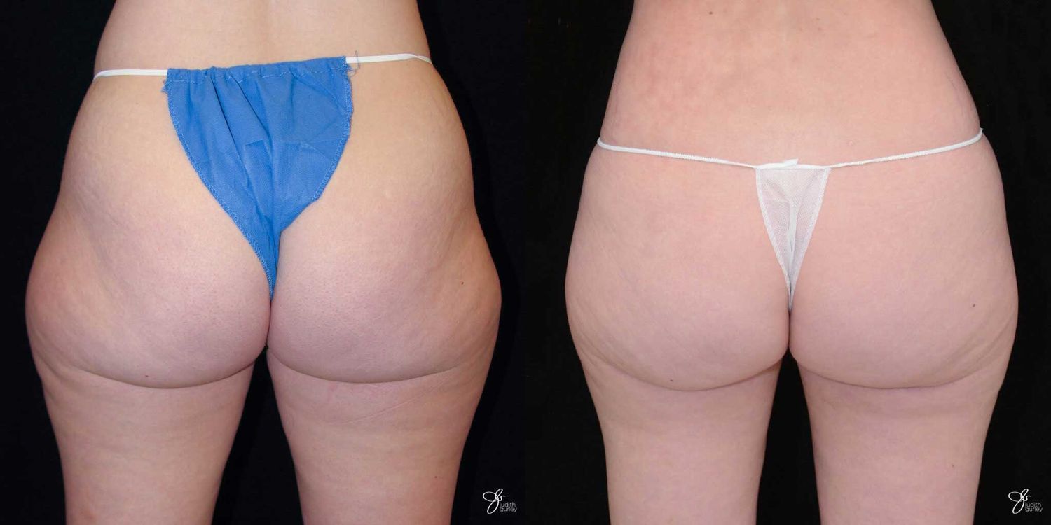 Comparison of two thong styles on model.