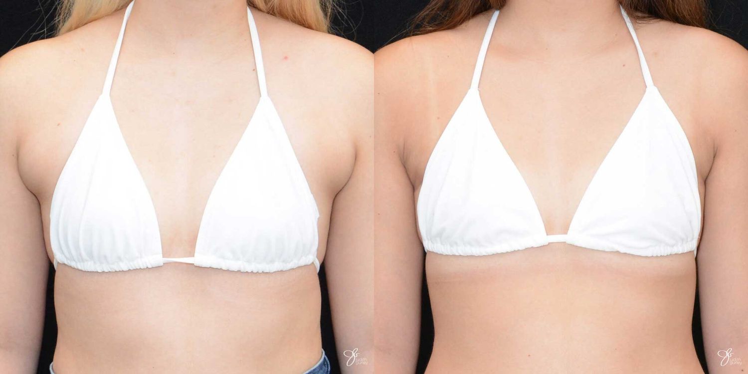 Two models wearing white triangle bikini tops.