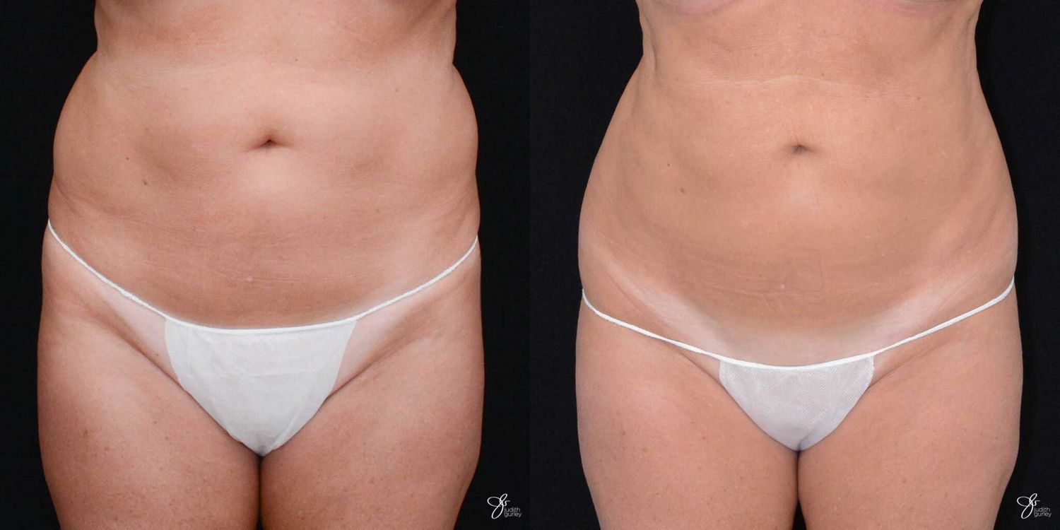 Before and after body contouring comparison image.