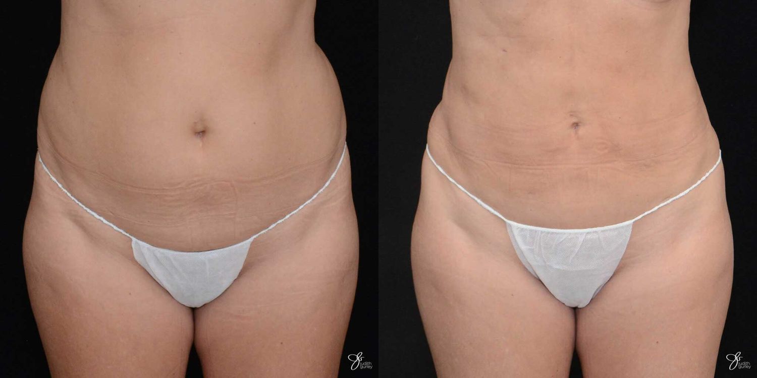 Before and after body contouring results.