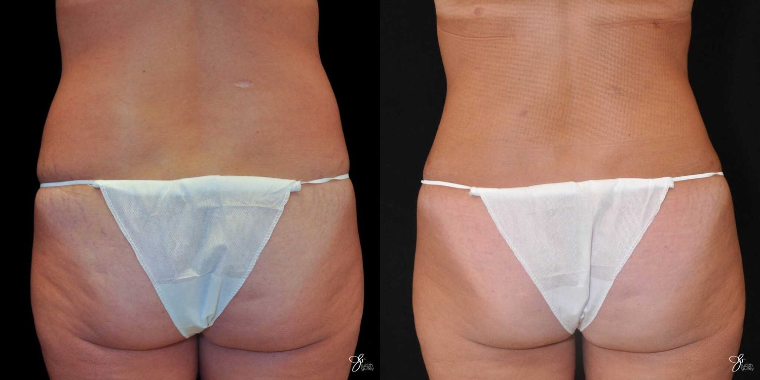Before and after body contouring treatment comparison.