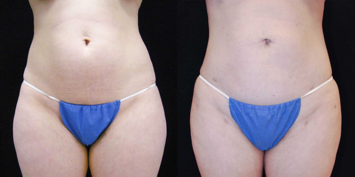Before and after body contouring comparison image.