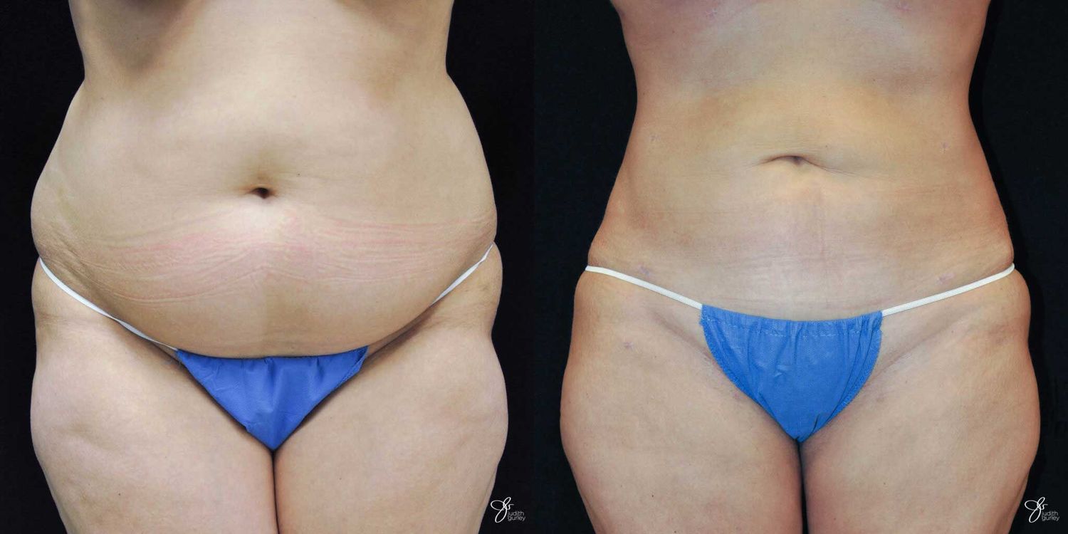 Before and after body contouring comparison.