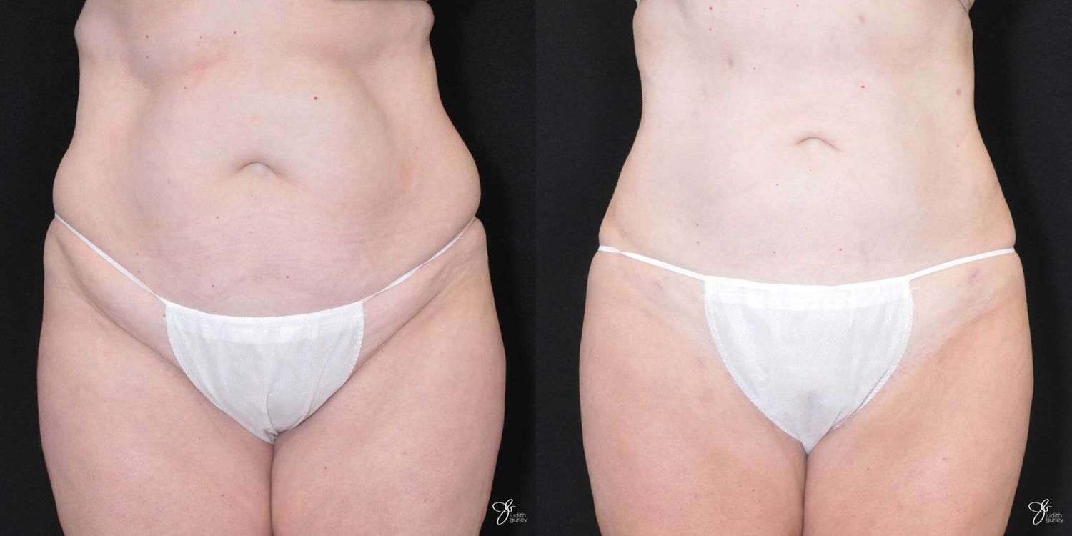 Before and after body image comparison.