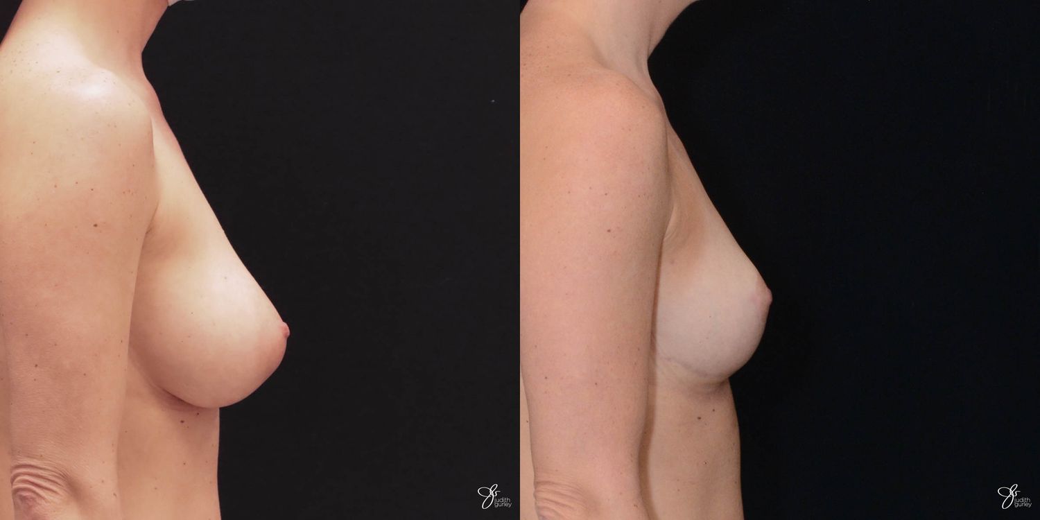 Breast Reduction Before & After