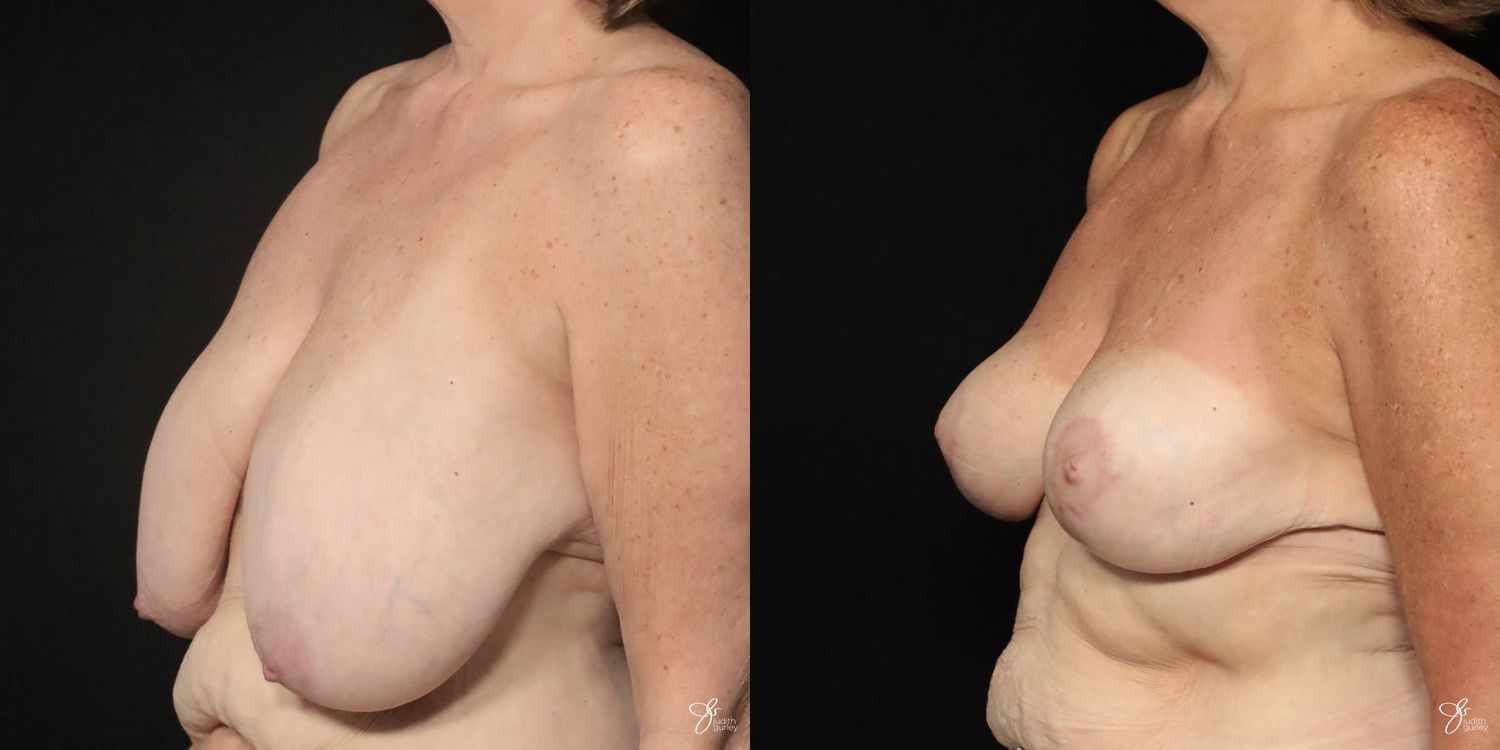 Breast Reduction Before & After