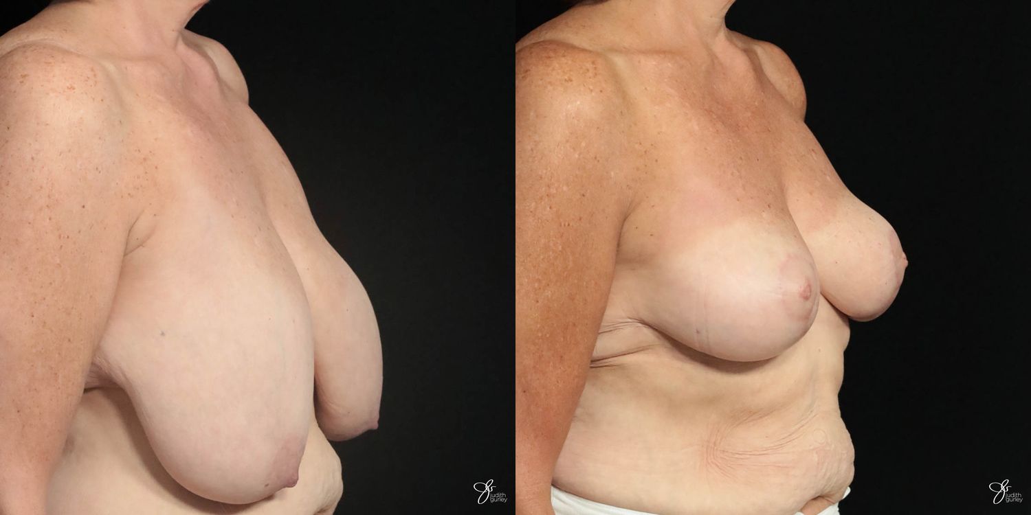 Breast Reduction Before & After