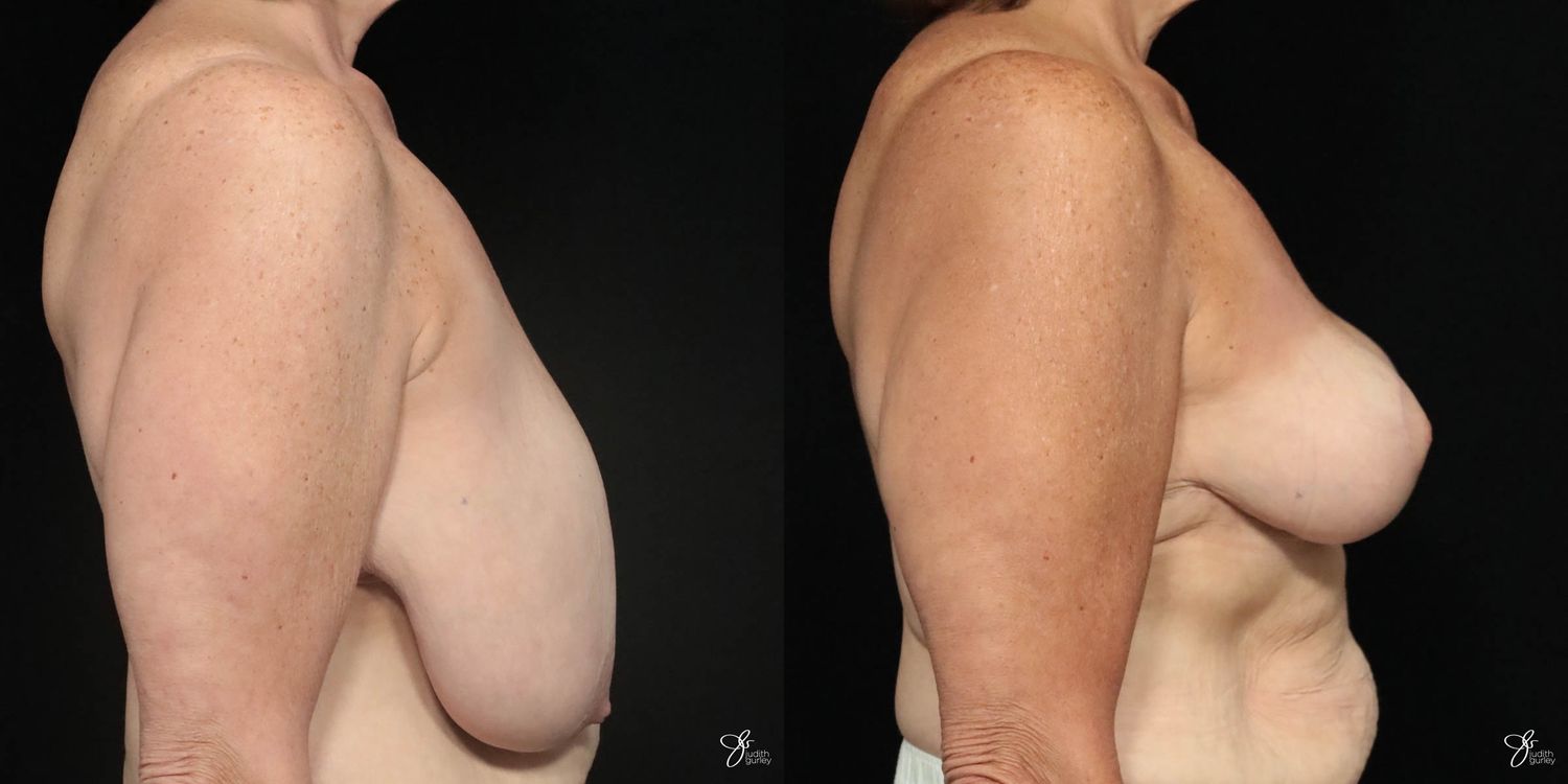 Breast Reduction Before & After