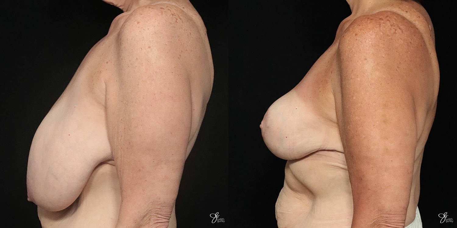 Breast Reduction Before & After