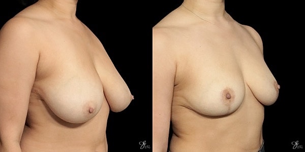 Breast Reduction Before & After