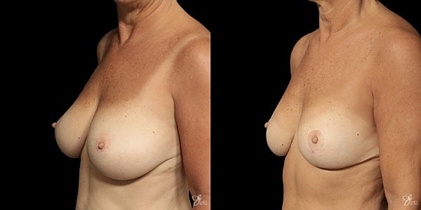 Breast Reduction Before & After