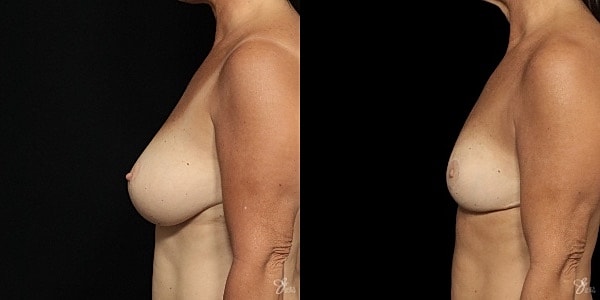 Breast Reduction Before & After