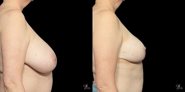 Breast Reduction Before & After