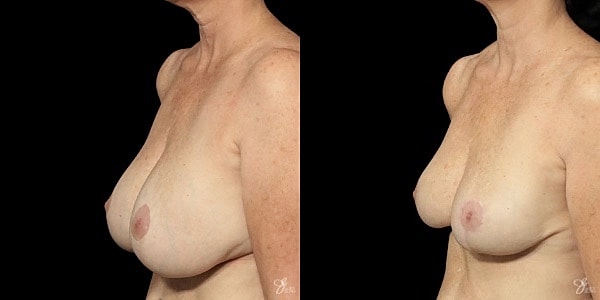 Breast Reduction Before & After