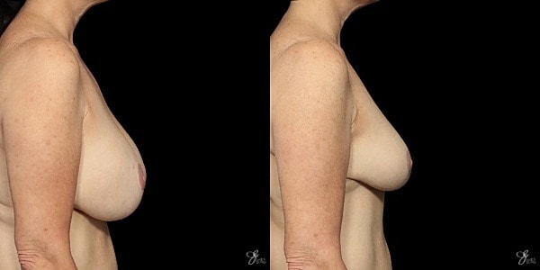 Breast Reduction Before & After