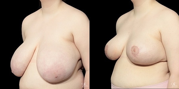 Breast Reduction Before & After