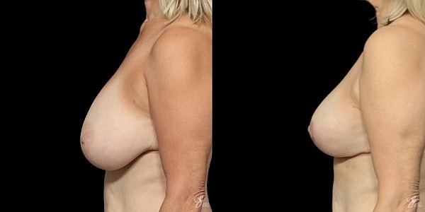 Breast Reduction Before & After