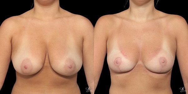 Breast Reduction Before & After