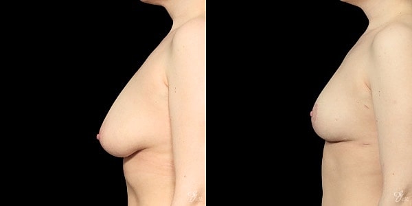 Breast Reduction Before & After