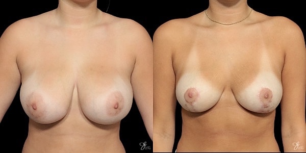 Breast Reduction Before & After