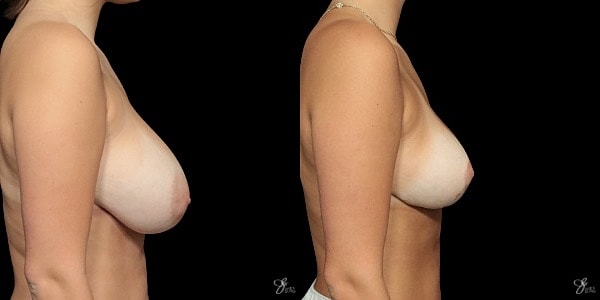 Breast Reduction Before & After