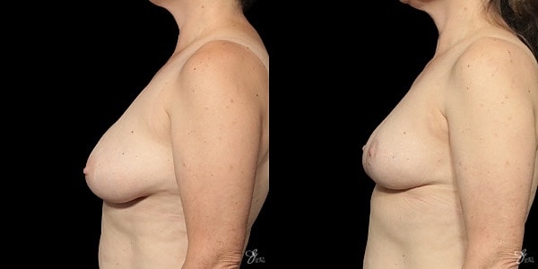 Breast Reduction Before & After