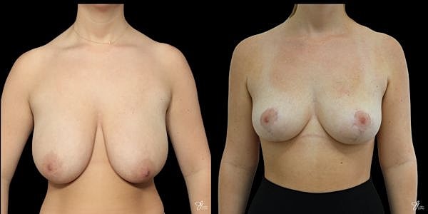 Breast Reduction Before & After
