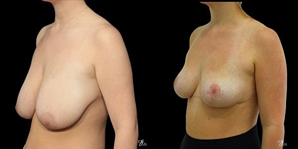 Breast Reduction Before & After