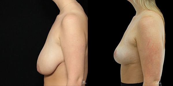 Breast Reduction Before & After