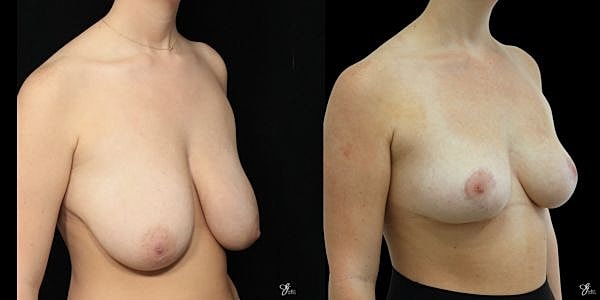 Breast Reduction Before & After