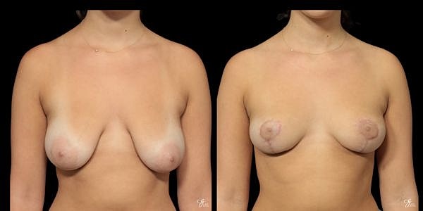 Breast Reduction Before & After