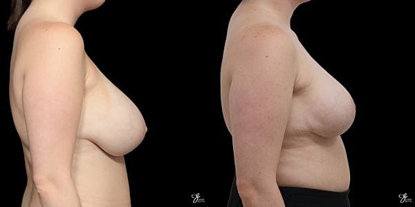 Breast Reduction Before & After