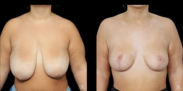 Breast Reduction Before & After