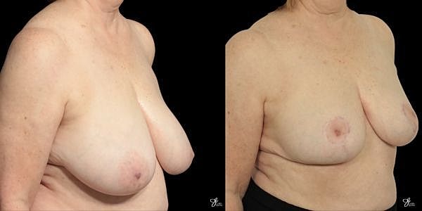 Breast Reduction Before & After