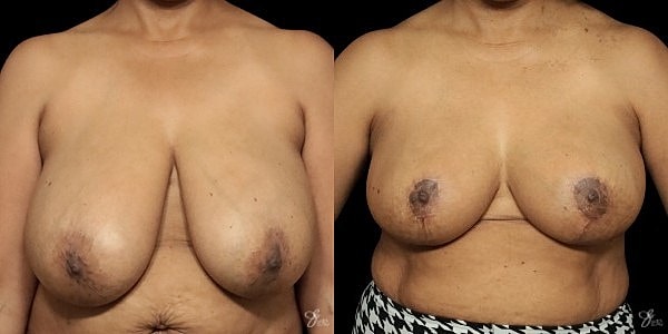 Breast Reduction Before & After