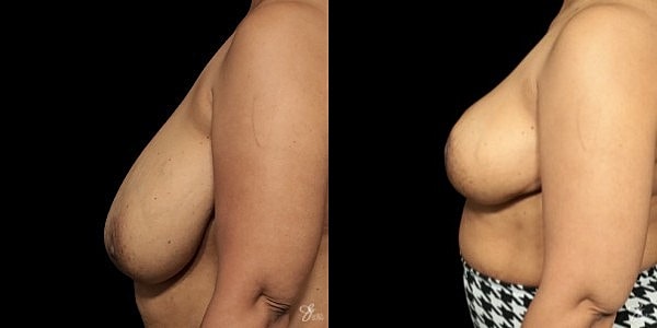 Breast Reduction Before & After