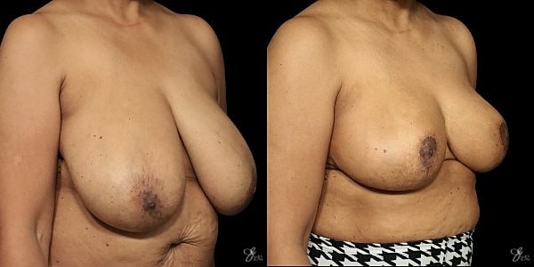 Breast Reduction Before & After