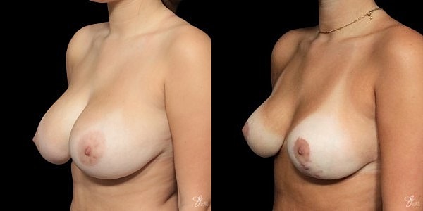 Breast Reduction Before & After