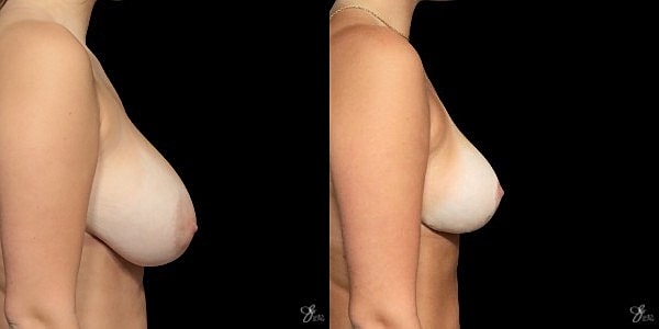 Breast Reduction Before & After