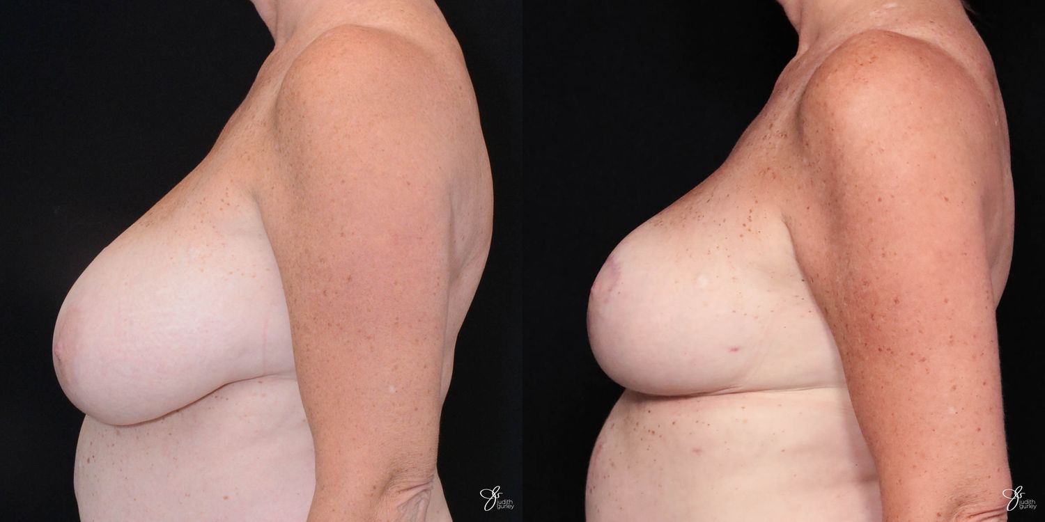 Breast Reduction Before & After