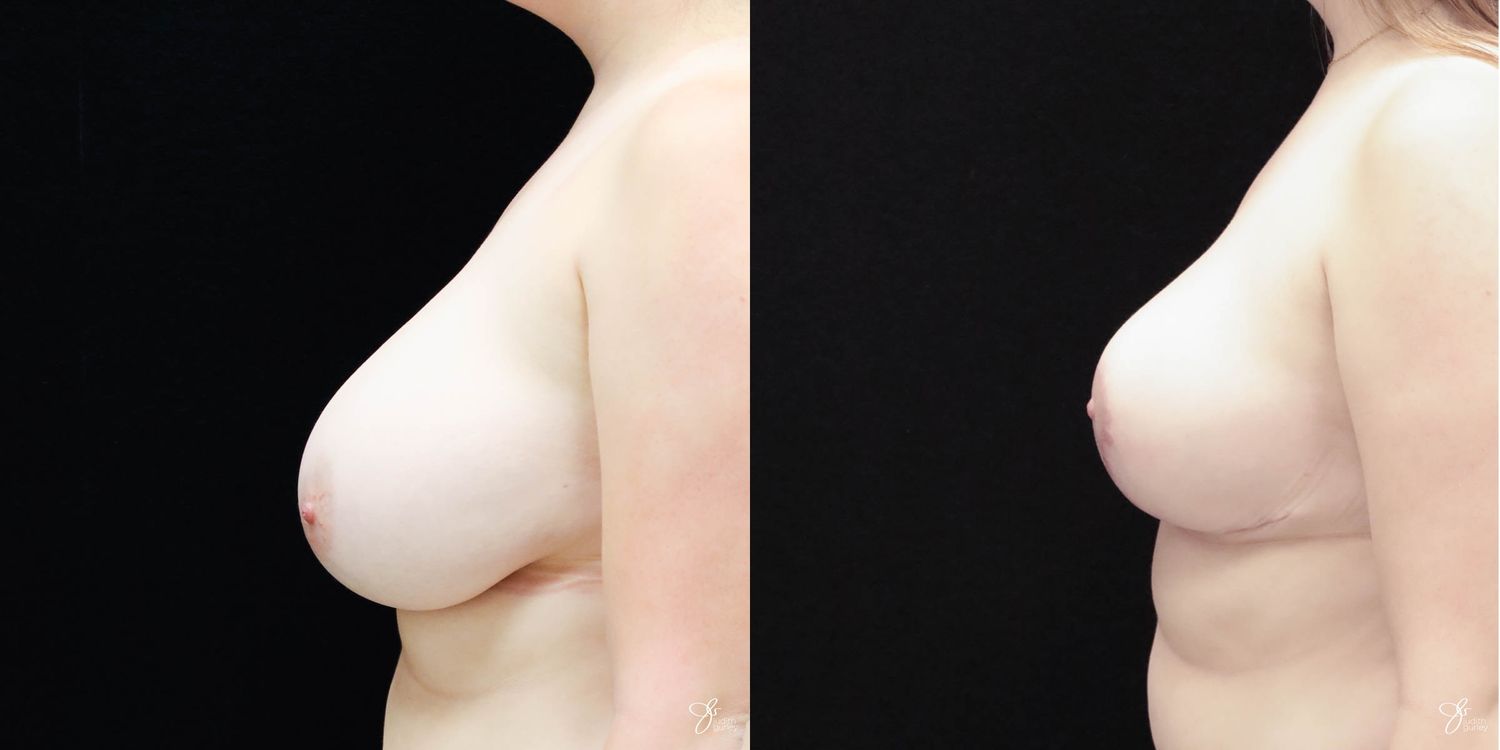 Breast Reduction Before & After