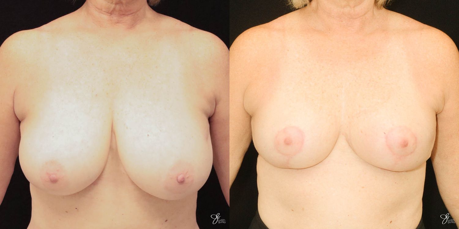 Breast Reduction Before & After
