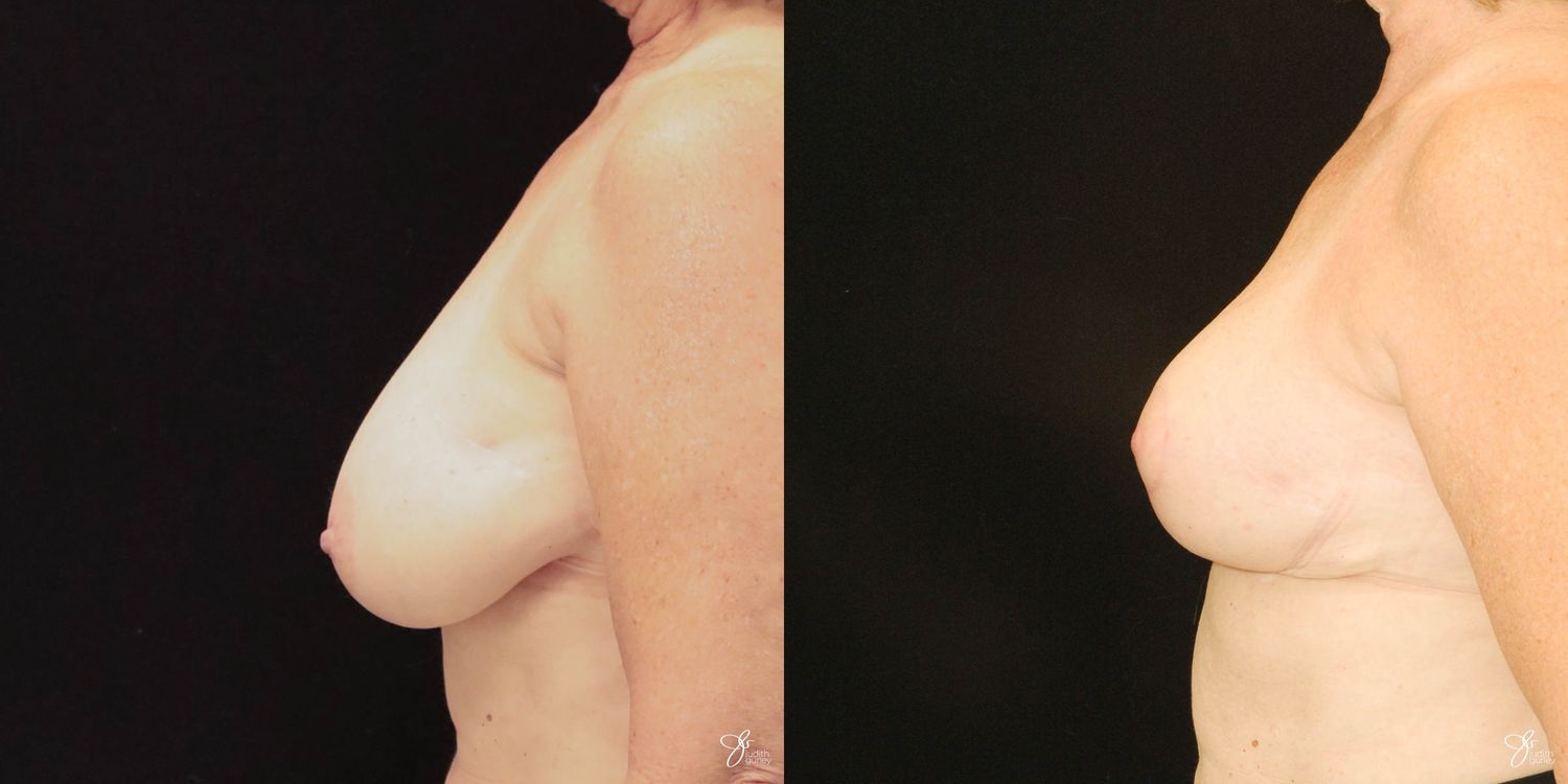 Breast Reduction Before & After