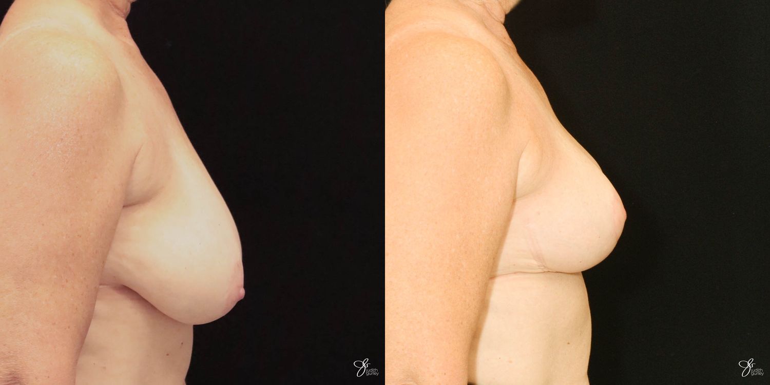 Breast Reduction Before & After