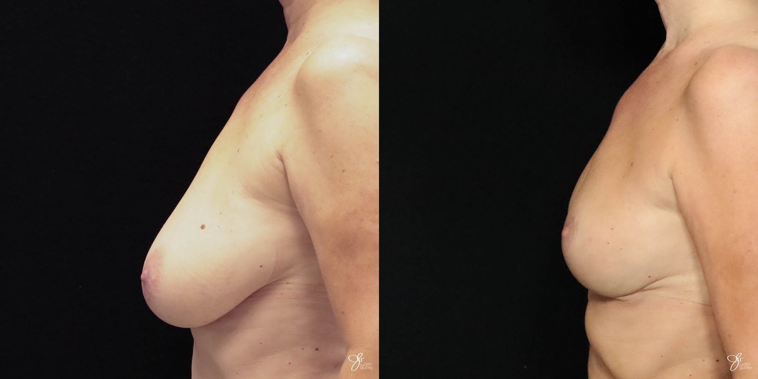 Breast Reduction Before & After