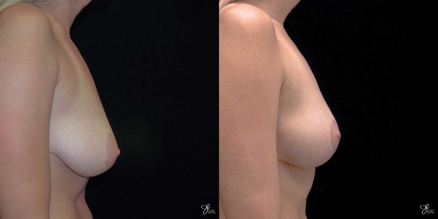 Breast Reduction Before & After